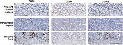 The Two Faces of Tumor-Associated Macrophages and Their Clinical Significance in Colorectal Cancer